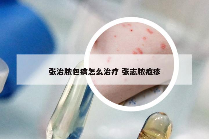 张治脓包病怎么治疗 张志脓疱疹