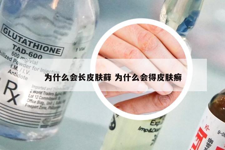 为什么会长皮肤藓 为什么会得皮肤癣