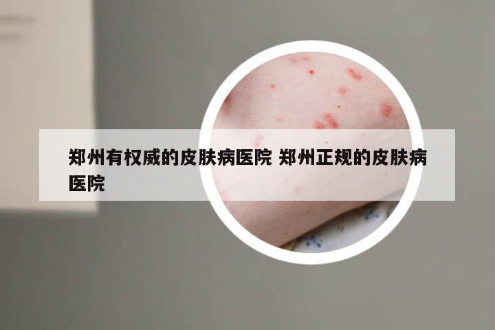 郑州有权威的皮肤病医院 郑州正规的皮肤病医院