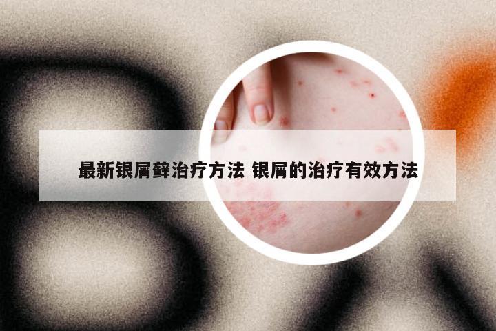最新银屑藓治疗方法 银屑的治疗有效方法