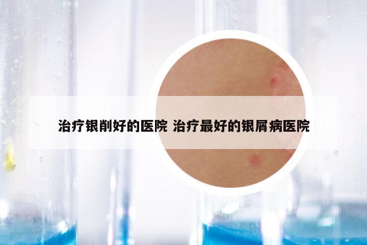 治疗银削好的医院 治疗最好的银屑病医院