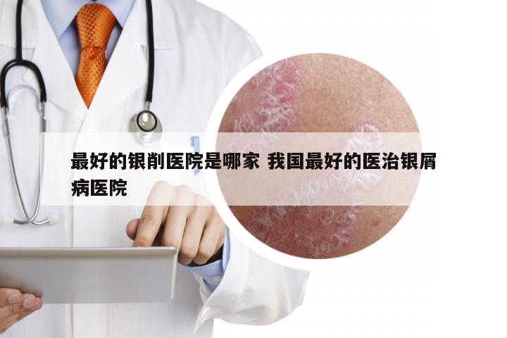 最好的银削医院是哪家 我国最好的医治银屑病医院