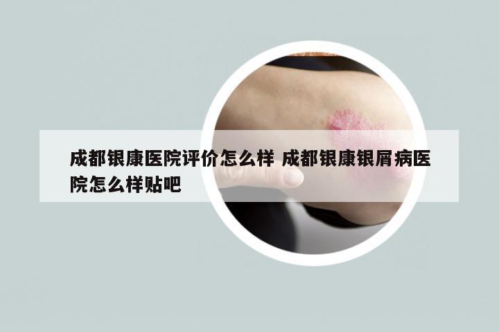 成都银康医院评价怎么样 成都银康银屑病医院怎么样贴吧