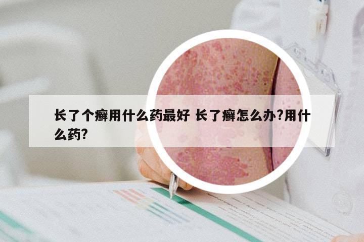 长了个癣用什么药最好 长了癣怎么办?用什么药?