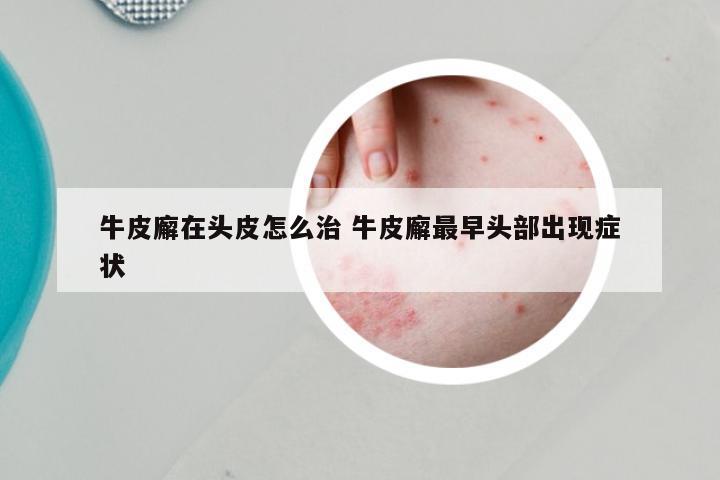 牛皮廨在头皮怎么治 牛皮廨最早头部出现症状