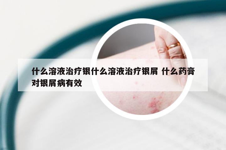 什么溶液治疗银什么溶液治疗银屑 什么药膏对银屑病有效