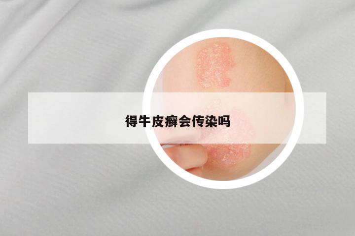 得牛皮癣会传染吗