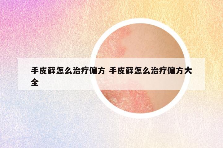 手皮藓怎么治疗偏方 手皮藓怎么治疗偏方大全
