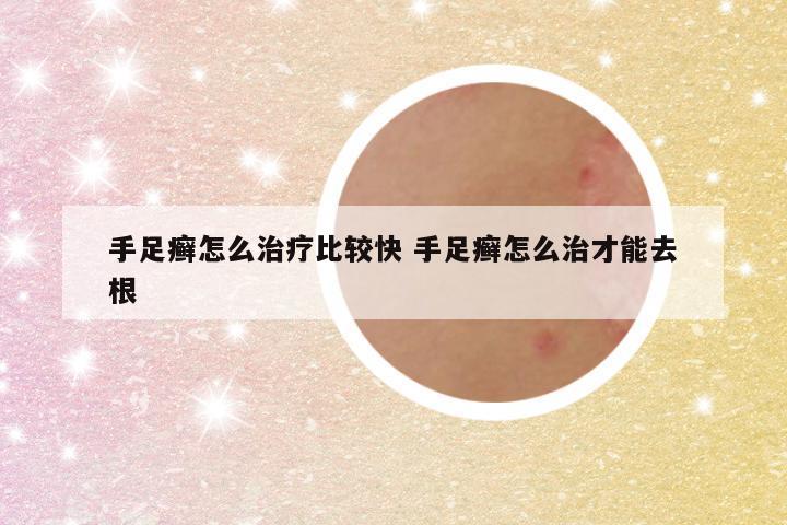 手足癣怎么治疗比较快 手足癣怎么治才能去根