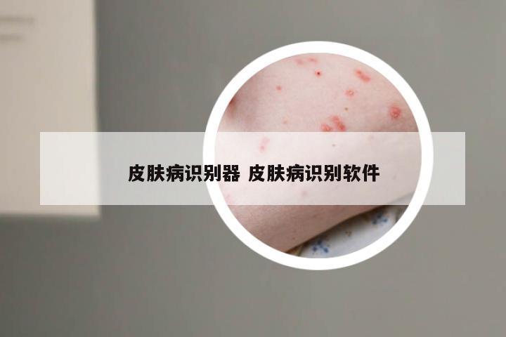 皮肤病识别器 皮肤病识别软件