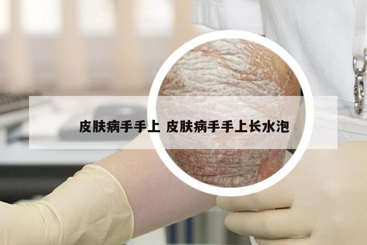 皮肤病手手上 皮肤病手手上长水泡