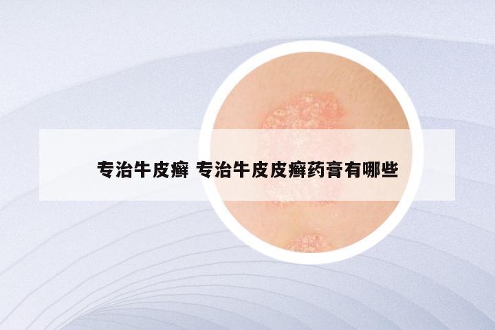 专治牛皮癣 专治牛皮皮癣药膏有哪些