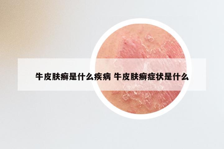 牛皮肤癣是什么疾病 牛皮肤癣症状是什么
