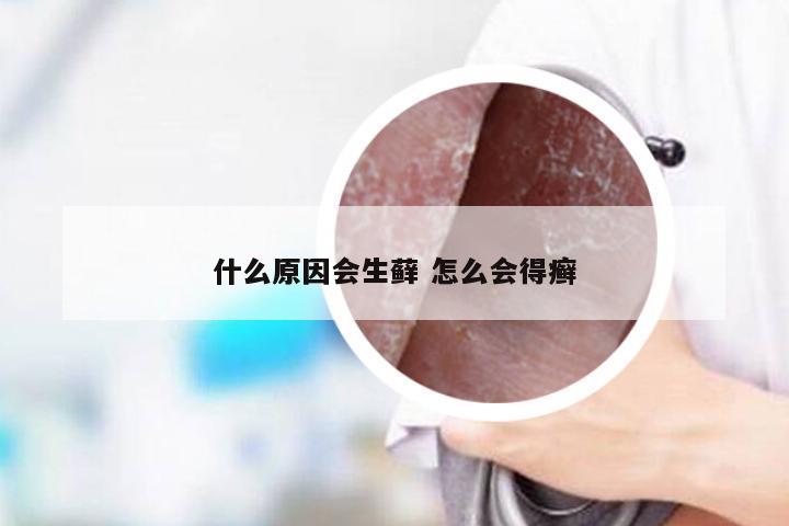 什么原因会生藓 怎么会得癣