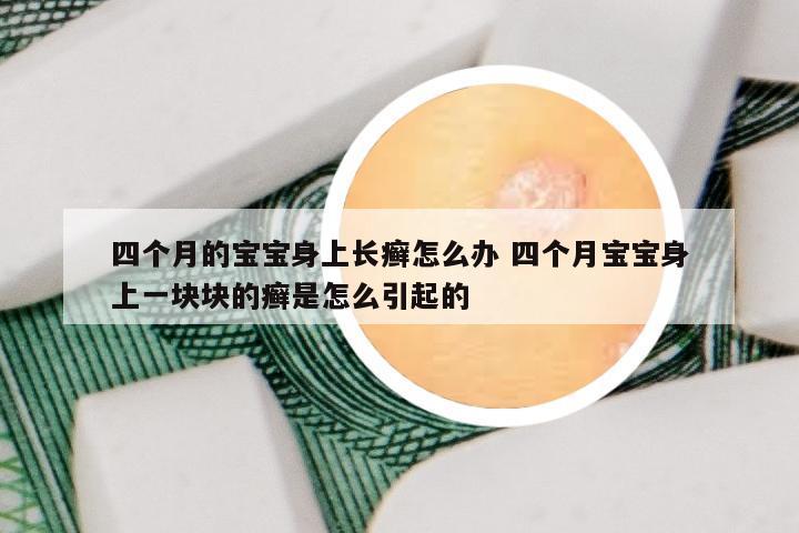 四个月的宝宝身上长癣怎么办 四个月宝宝身上一块块的癣是怎么引起的