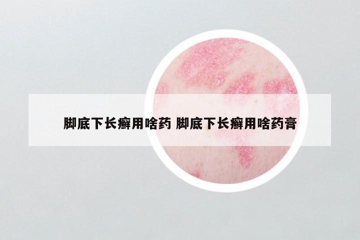 脚底下长癣用啥药 脚底下长癣用啥药膏