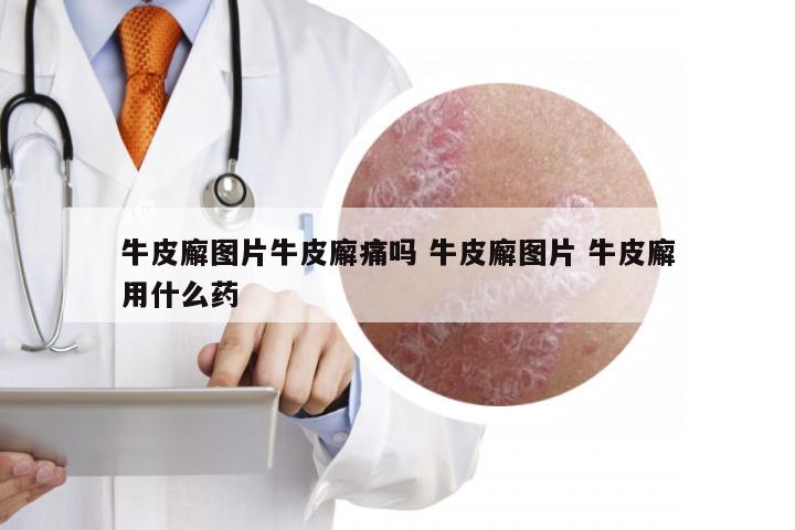 牛皮廨图片牛皮廨痛吗 牛皮廨图片 牛皮廨用什么药