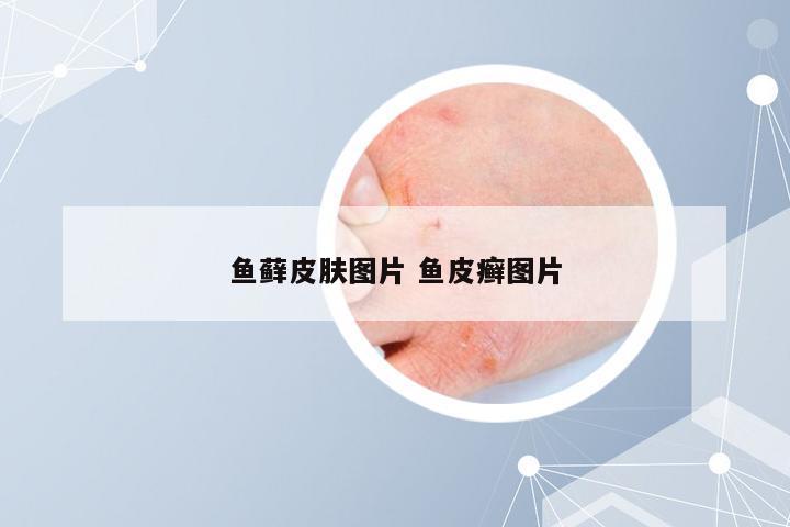 鱼藓皮肤图片 鱼皮癣图片