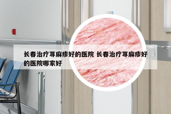 长春治疗荨麻疹好的医院 长春治疗荨麻疹好的医院哪家好