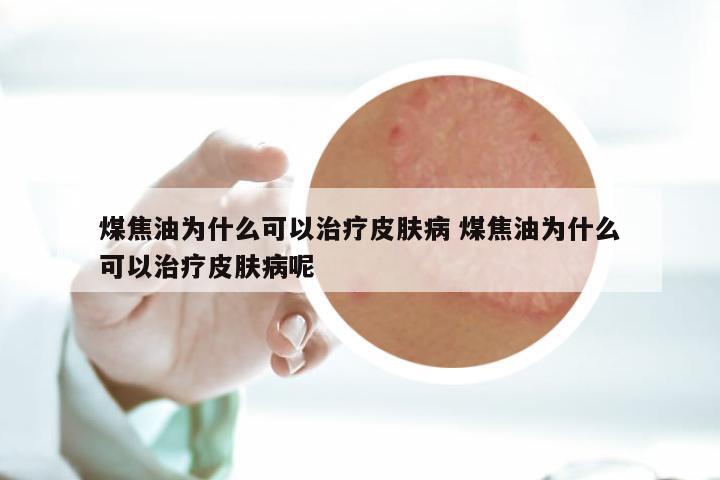 煤焦油为什么可以治疗皮肤病 煤焦油为什么可以治疗皮肤病呢