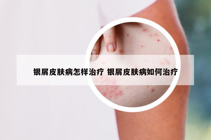 银屑皮肤病怎样治疗 银屑皮肤病如何治疗