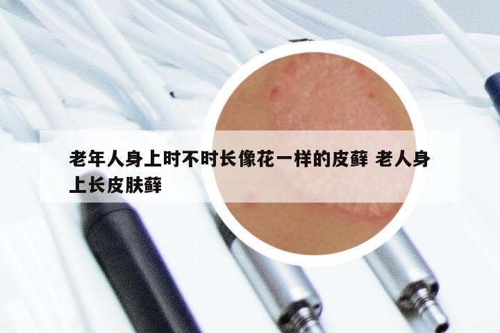 老年人身上时不时长像花一样的皮藓 老人身上长皮肤藓