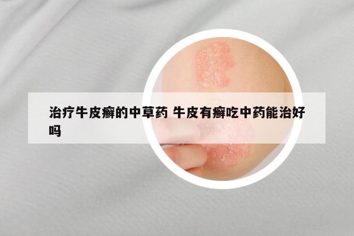 治疗牛皮癣的中草药 牛皮有癣吃中药能治好吗
