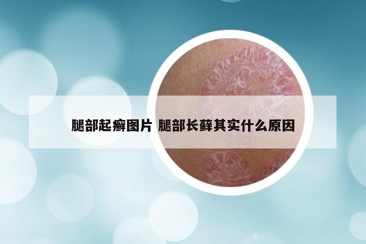 腿部起癣图片 腿部长藓其实什么原因