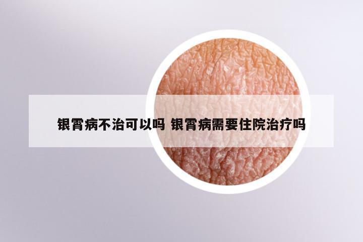 银霄病不治可以吗 银霄病需要住院治疗吗