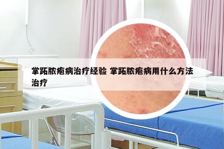 掌跖脓疱病治疗经验 掌跖脓疱病用什么方法治疗