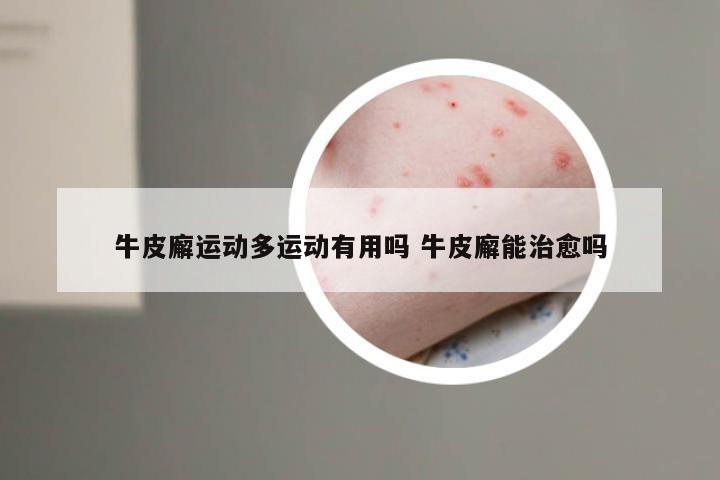 牛皮廨运动多运动有用吗 牛皮廨能治愈吗