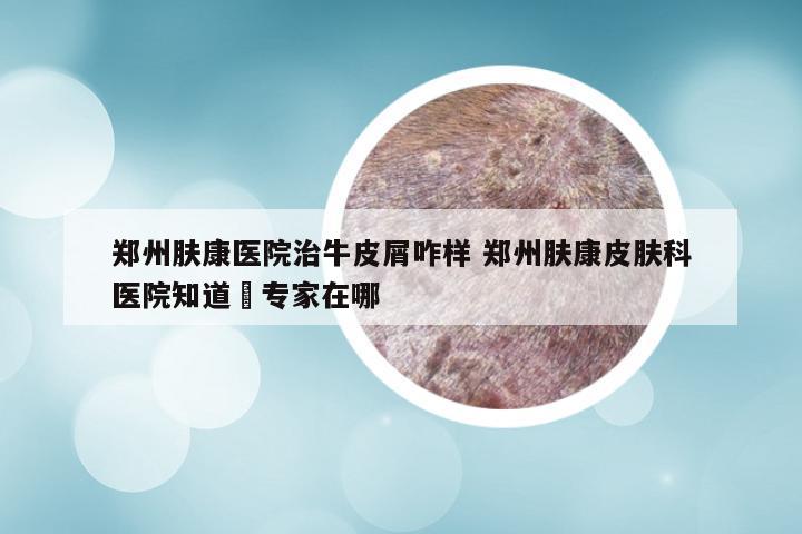 郑州肤康医院治牛皮屑咋样 郑州肤康皮肤科医院知道▪专家在哪