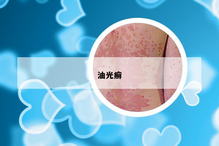 油光癣
