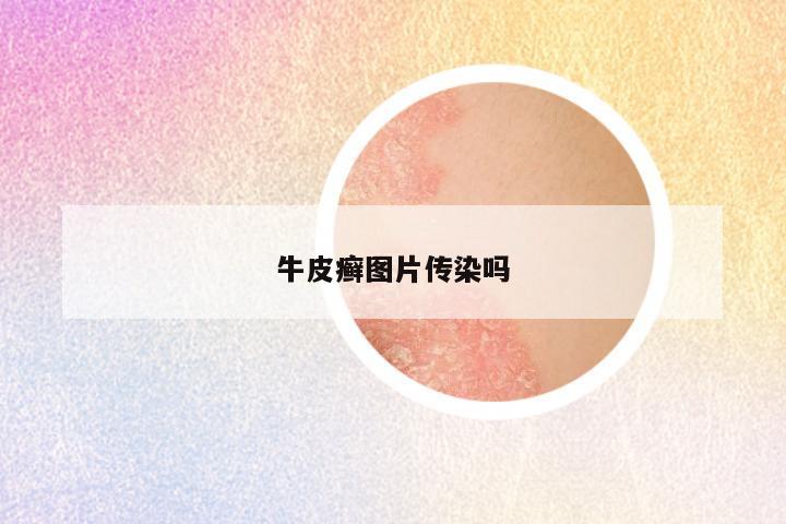 牛皮癣图片传染吗