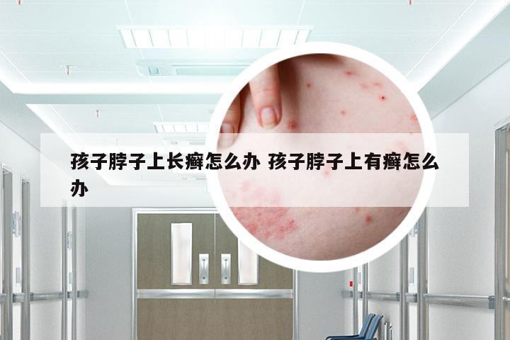 孩子脖子上长癣怎么办 孩子脖子上有癣怎么办