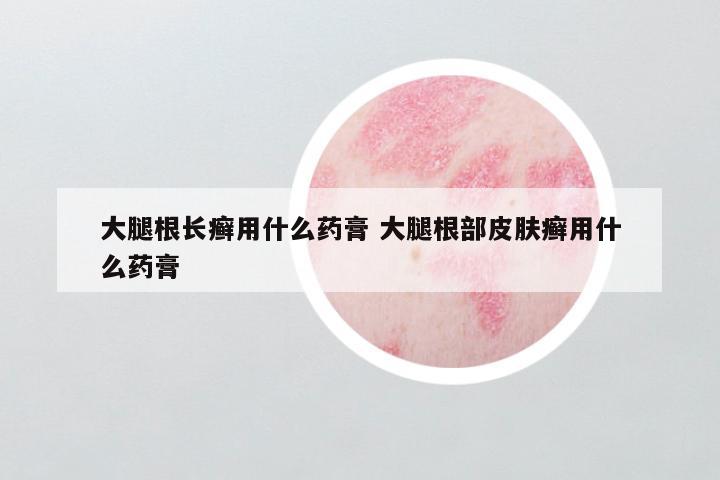 大腿根长癣用什么药膏 大腿根部皮肤癣用什么药膏