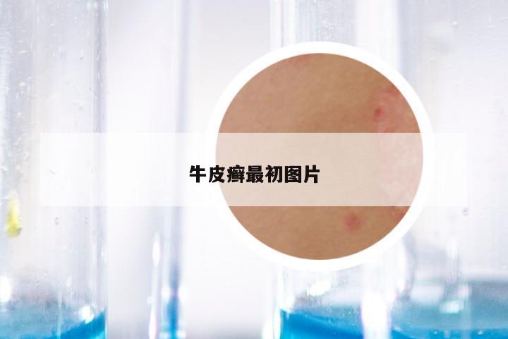 牛皮癣最初图片