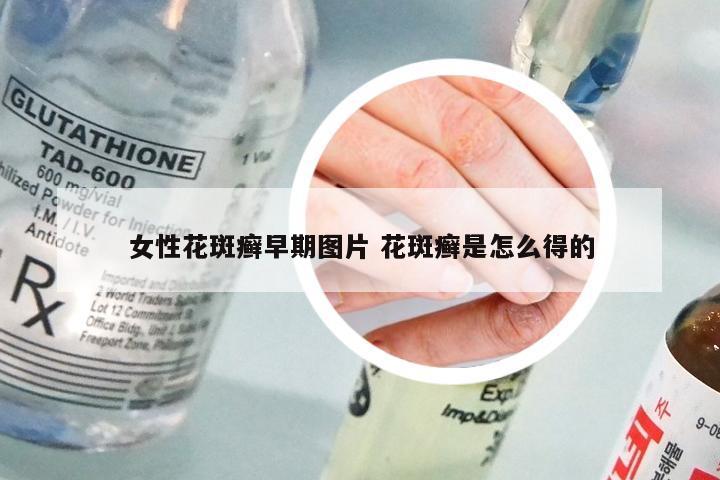 女性花斑癣早期图片 花斑癣是怎么得的