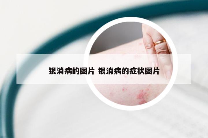 银消病的图片 银消病的症状图片