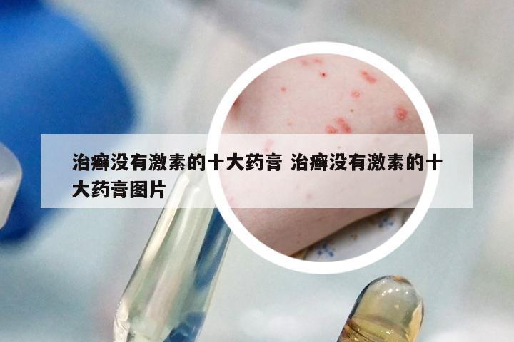 治癣没有激素的十大药膏 治癣没有激素的十大药膏图片
