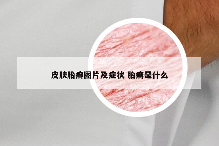 皮肤胎癣图片及症状 胎癣是什么