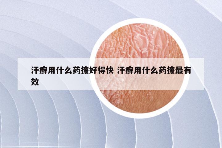 汗癣用什么药擦好得快 汗癣用什么药擦最有效
