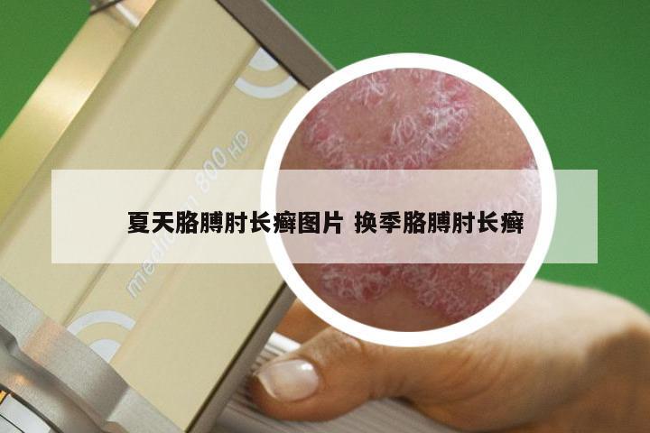 夏天胳膊肘长癣图片 换季胳膊肘长癣