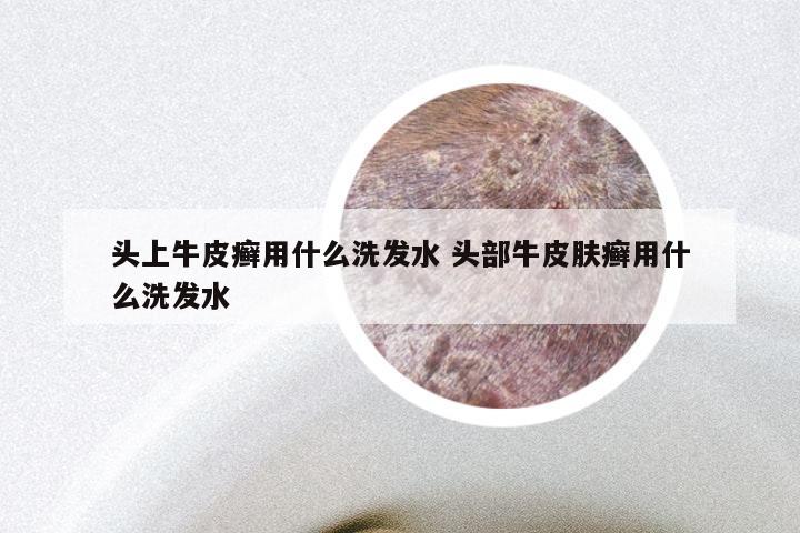 头上牛皮癣用什么洗发水 头部牛皮肤癣用什么洗发水