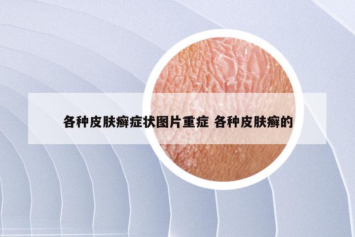 各种皮肤癣症状图片重症 各种皮肤癣的