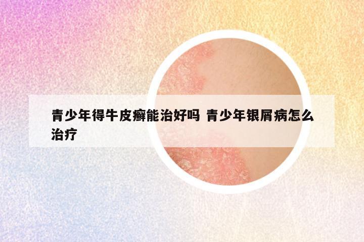 青少年得牛皮癣能治好吗 青少年银屑病怎么治疗