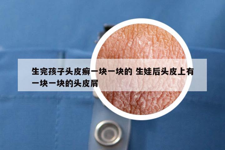生完孩子头皮癣一块一块的 生娃后头皮上有一块一块的头皮屑