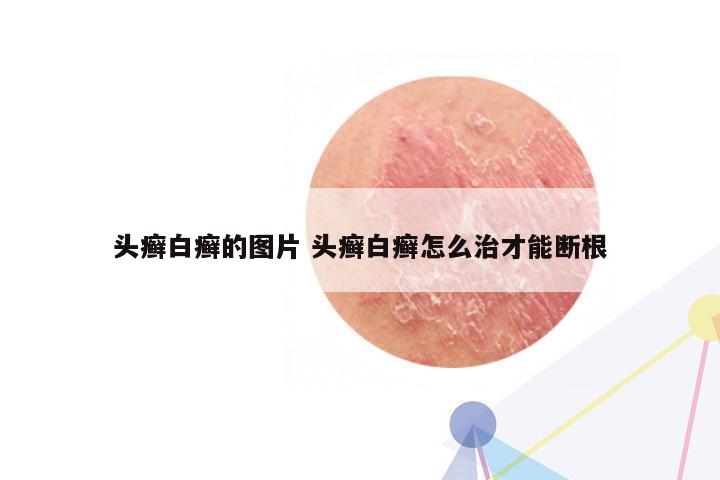头癣白癣的图片 头癣白癣怎么治才能断根