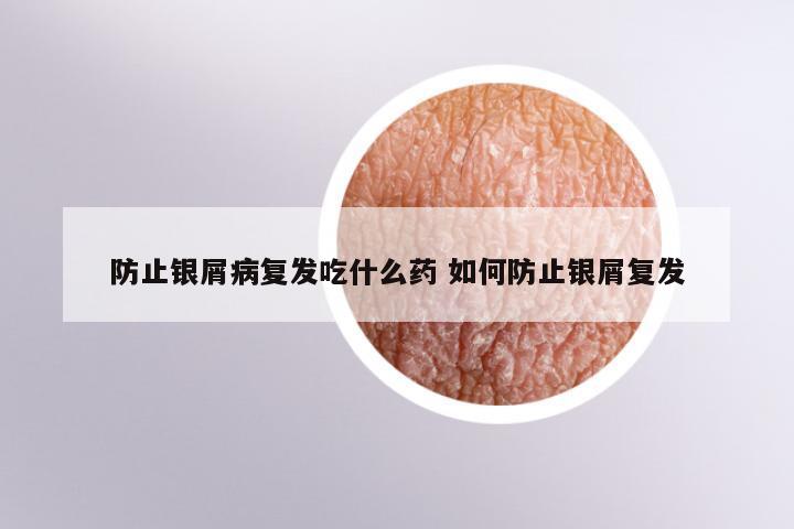 防止银屑病复发吃什么药 如何防止银屑复发