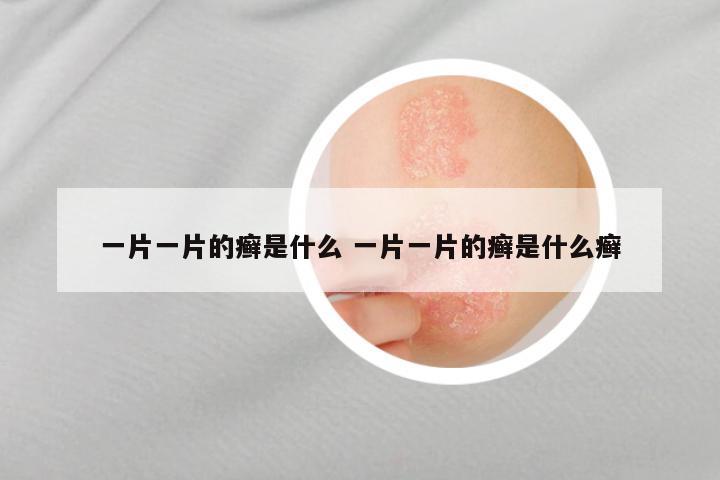 一片一片的癣是什么 一片一片的癣是什么癣